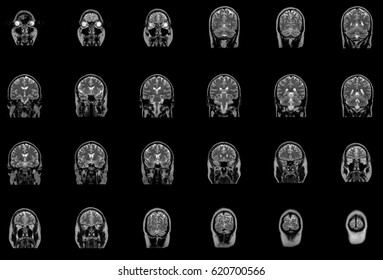 Magnetic Resonance Imaging Of Brain Stem