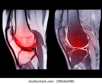 Magnetic Resonance Imaging Or MRI Knee Comparison Sagittal PDW And TIW View For Detect Tear Or Sprain Of The Anterior Cruciate  Ligament (ACL).