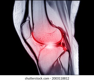 Magnetic Resonance Imaging Or MRI Knee Sagittal PDW And TIW View For Detect Tear Or Sprain Of The Anterior Cruciate  Ligament (ACL).