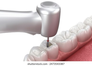 Making access to the root canal. Medically accurate tooth 3D illustration.