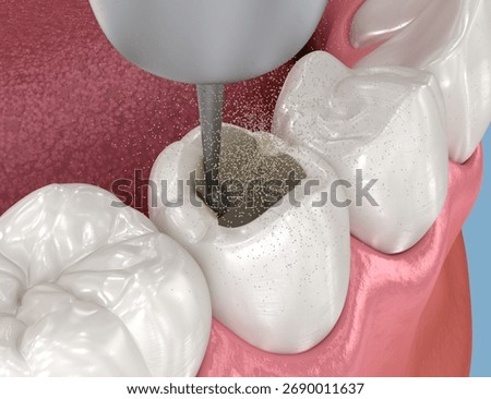 Making access to the root canal. Medically accurate tooth 3D illustration.
