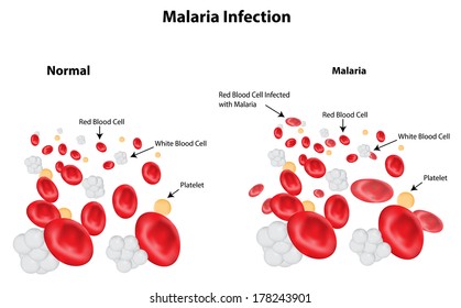 Malaria