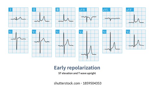repolarization of the heart