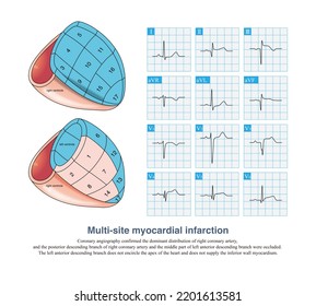 1,876 Chest Ekg Images, Stock Photos & Vectors | Shutterstock