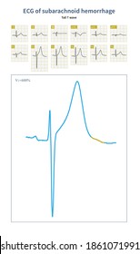 Male, 52 years old, clinically diagnosed with subarachnoid hemorrhage. The electrocardiogram showed that the T wave amplitude increased and the base was widened.