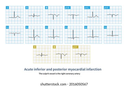 30 Extensive anterior myocardial infarction Images, Stock Photos ...