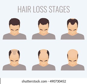 Male alopecia stages set. Top view portrait of a man losing hair. Male pattern baldness. 
