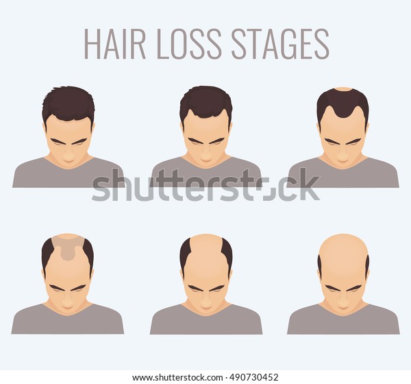 Male Alopecia Stages Set Top View Stock Illustration 490730452