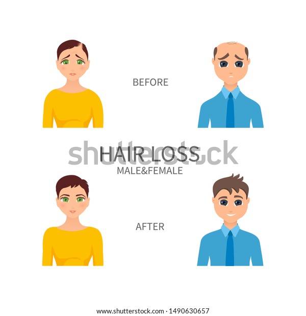 Male Female Pattern Baldness Androgenetic Alopecia Stock