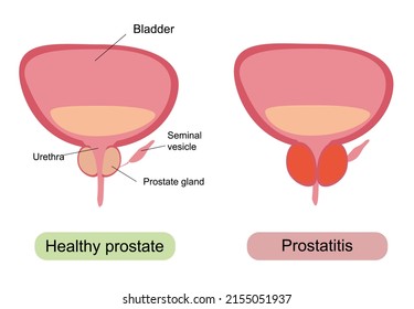 Femboy Prostate