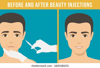 Man Anti-aging Skin Care And Men Cosmetics. Different Types Of Facial Wrinkles. Man Before And After Botox Injection. Anti-aging Procedure.