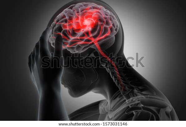 Man Headache Stroke 3d Illustration Stock Illustration 1573031146 Man Headache Stroke 3d Illustration Stock Illustration 1573031146