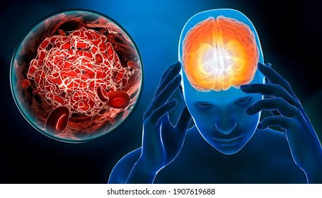 Man suffering of a cerebrovascular accident or stroke or brain attack with blood clot or thrombus 3D rendering illustration. Medicine, medical pathology, health, brain injury, science concepts.