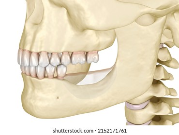 Mandibular Jaw, Bone Recession After Losing Molars Teeth. Dental 3D Illustration