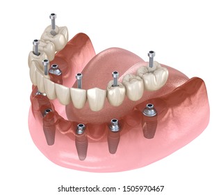 Mandibular prosthesis All on 4 system supported by implants, screw fixation. Medically accurate 3D illustration of dental concept