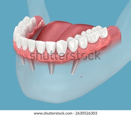 Mandibular prosthesis console based on 4 implants.  Medically accurate 3D illustration of human teeth and dentures concept