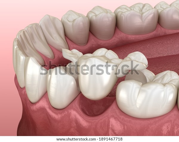 Maryland\
bridge made from ceramic, premolar tooth recovery. Medically\
accurate 3D illustration of dental\
concept