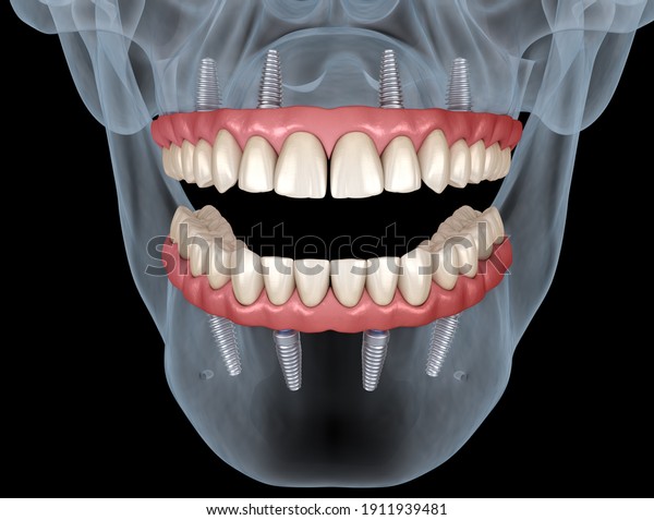 インプラントによって支えられる4系統の歯茎を持つ上顎と下顎の補綴物 人間の歯と歯の医学的に正確な3dイラスト のイラスト素材