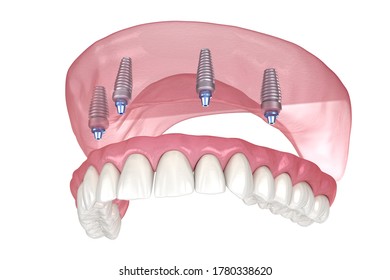 Maxillary prosthesis with gum All on 4 system supported by implants. Medically accurate 3D illustration of human teeth and dentures