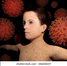 Measles Outbreak Related Illustration Depicting A Child Covered In Skin Sores With Enlarged Measles Viruses Surrounding Him.