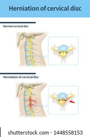 
Mechal Illustration For Cervical Disc Herniation(300dpi A2size Jpeg)