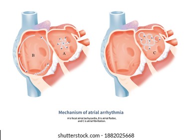 The Mechanism Of Atrial Fibrillation Is That There Are Many Small Reentries In The Atrium, That Is, Wavelet, Which Produce Different Electrical Excitations And Form Disordered Atrial Arrhythmia.