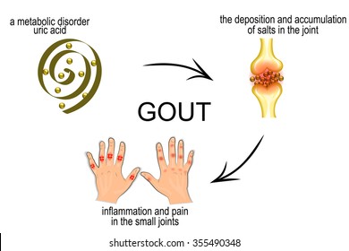 The Mechanism Of Development Of Gout. Pain In The Joints.