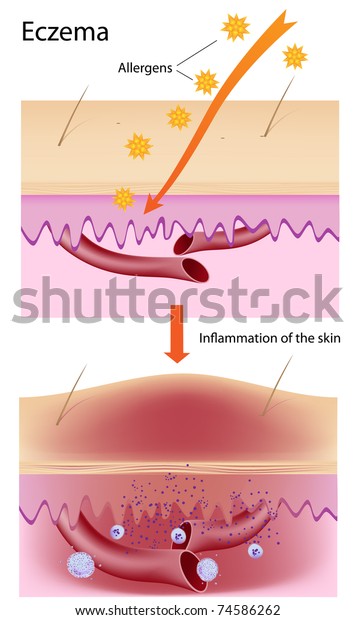 Mechanism Eczema Stock Illustration 74586262