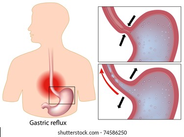 Mechanism Of Gastric Reflux