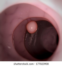 Medical 3d Illustration - Colon Polyp