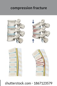 2,377 Compression fracture Images, Stock Photos & Vectors | Shutterstock