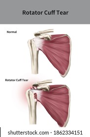 158 Rotator cuff tear Images, Stock Photos & Vectors | Shutterstock