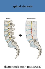 
Medical 3D Illustration For Explanation Spinal Stenosis