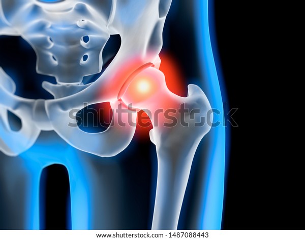Medical 3d Illustration Painful Hip Joint Stock Illustration 1487088443
