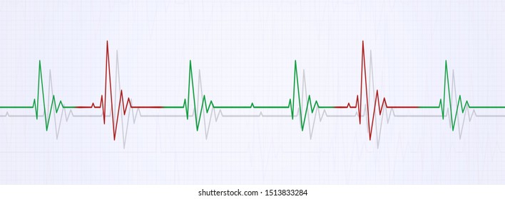 Medical Banner Illustrating Irregular Heart Beat On Ecg. Heart Arrhythmia