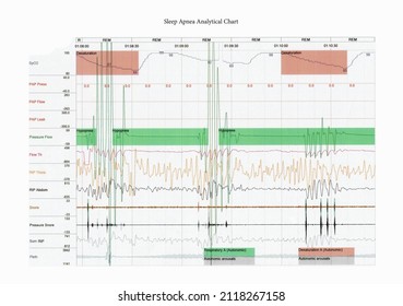 Medical Examine Report Of Obstructive Sleep Apnea Symptom Chart From Sleep Lab Test For Doctor To Diagnostic Analytics Of Breathing Problem At Sleep