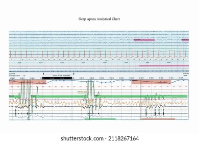 Medical Examine Report Of Obstructive Sleep Apnea Symptom Chart From Sleep Lab Test For Doctor To Diagnostic Analytics Of Breathing Problem At Sleep