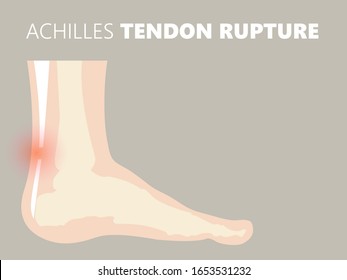medical illustration of Achilles tendon rupture by overstretch then tear and rupture from running and playing sports. Image foot anatomy with all tendons and bones problem from jumping and falling.