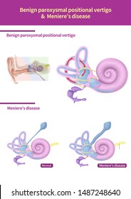 
Medical Illustration Of Benign Paroxysmal Positional Vertigo
And  Meniere’s Disease