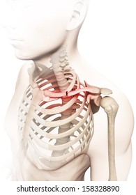 Medical Illustration Of A Broken Clavicle