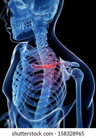 Medical Illustration Of A Broken Clavicle