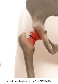 Medical Illustration Of Broken Hip