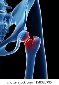 Medical Illustration Of Broken Hip