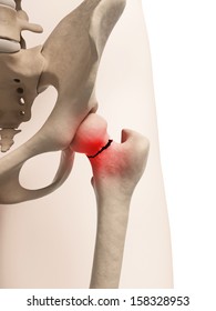 Medical Illustration Of Broken Hip