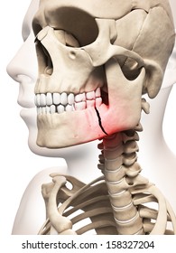 Medical Illustration Of A Broken Jaw Bone