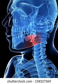 Medical Illustration Of A Broken Jaw Bone