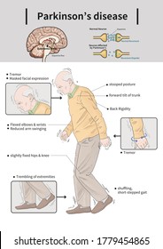 Medical Illustration Causes Symptoms Parkinsons Disease Stock ...