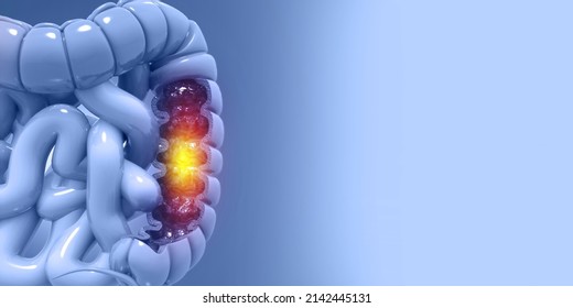 Medical Illustration Of Colon Cancer Concept. 3d Illustration