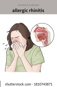 Medical Illustration To Explain Allergic Rhinitis