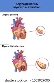 Angina Pectoris Images Stock Photos Vectors Shutterstock